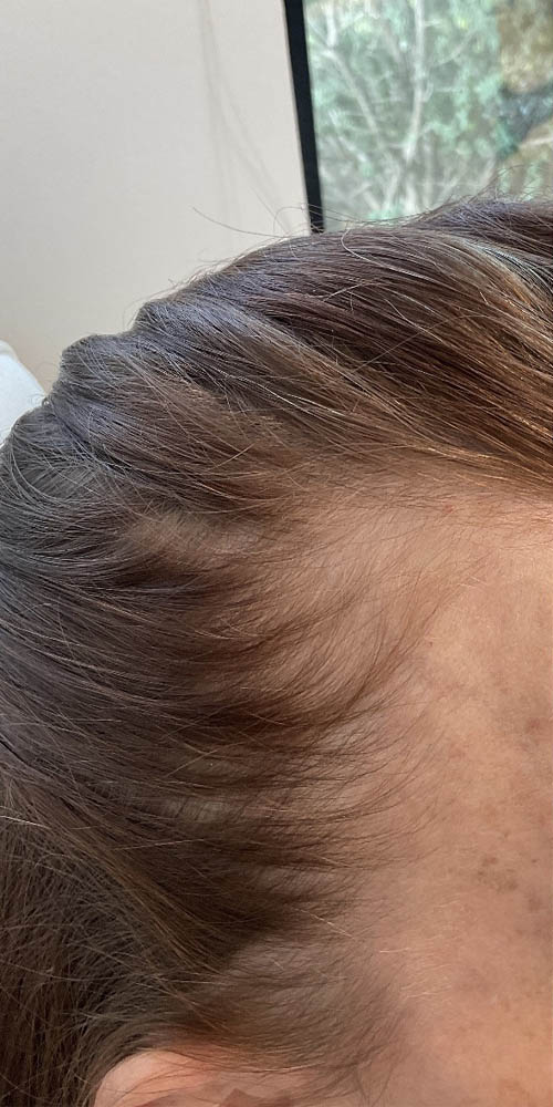 Hair Restoration