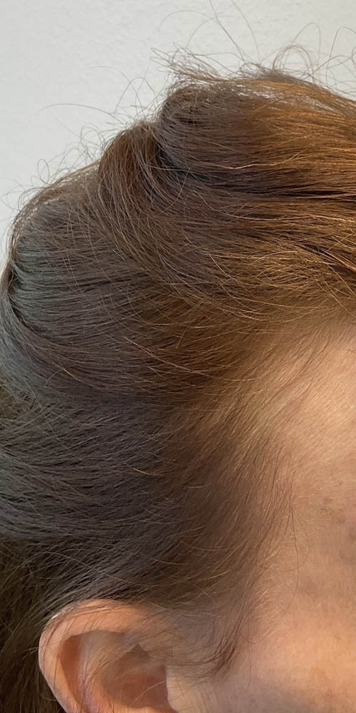Hair Restoration