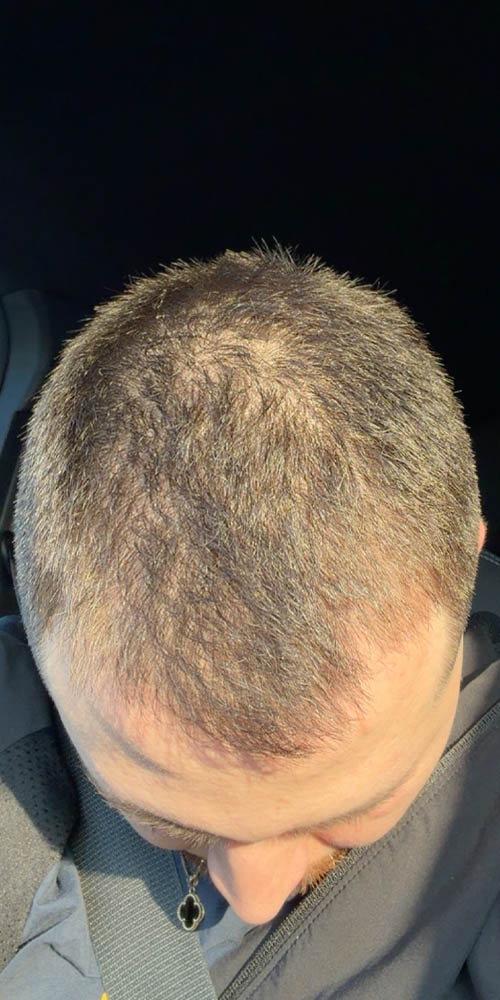 Hair Restoration