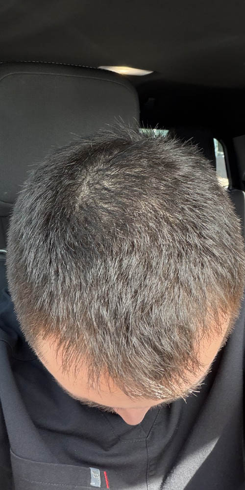Hair Restoration